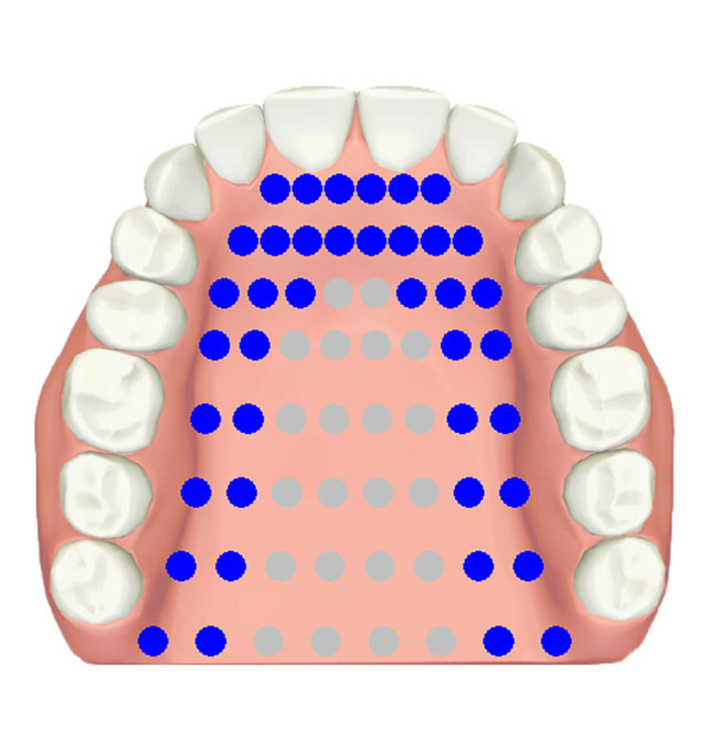 EPG contact pattern for alveolar stop /t/, /d/, /n/
